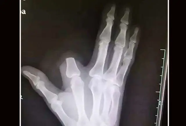 Мужчина отрезал себе палец после укуса змеи, но этим дело не закончилось